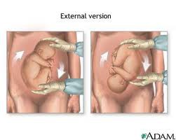 External Cephalic Version; There’s No Turning Back